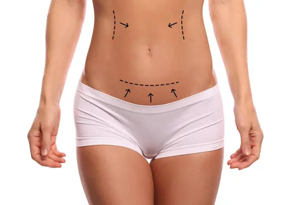 stock image Woman with markings for cosmetic surgery on her abdomen against white background, closeup