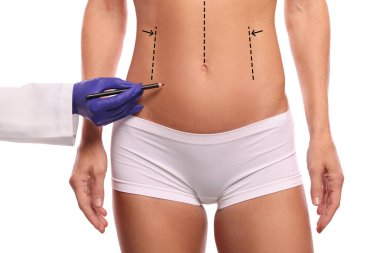Kadın estetik ameliyata hazırlanıyor, beyaz bir geçmişi var. Doktor karnına işaretler çiziyor, yakın plan.