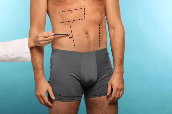 Man preparing for cosmetic surgery, light blue background. Doctor drawing markings on his abdomen, closeup