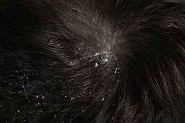 Koyu saçlı kepekli bir adam, makro manzaralı.