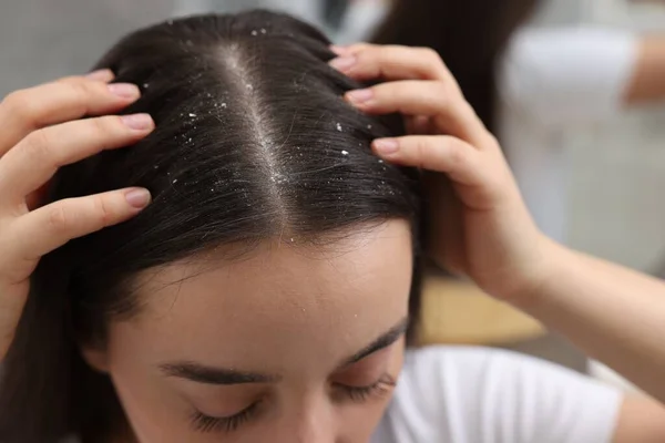 Woman examining her hair and scalp indoors, closeup. Dandruff problem