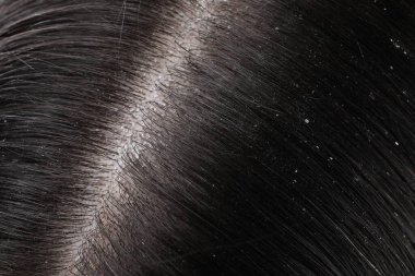 Koyu renk saçlı kepekli kadının yakın görüntüsü.