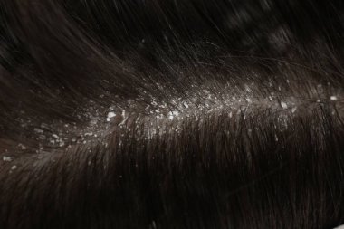 Koyu saçlı kepekli bir adam, makro manzaralı.