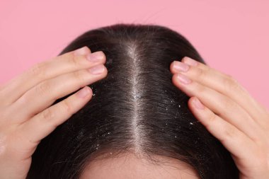 Woman with dandruff problem on pink background, closeup clipart