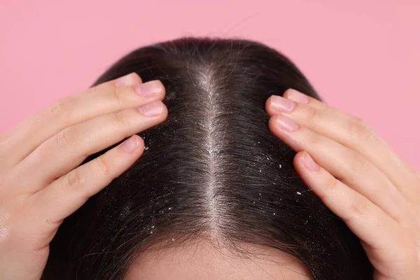 stock image Woman with dandruff problem on pink background, closeup