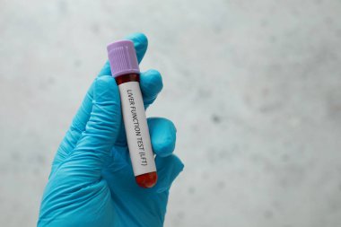 Laboratuvar çalışanı elinde kan örneği olan bir tüp tutuyor ve ışık arka planına karşı karaciğer fonksiyon testi yapıyor. Yakın plan. Metin için boşluk