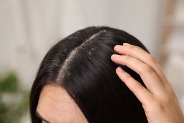 Woman examining her hair and scalp indoors, closeup. Dandruff problem clipart