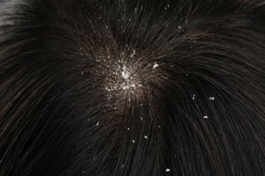 Koyu saçlı kepekli kadın, yakın çekim manzaralı.