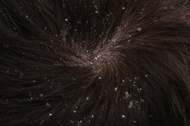 Koyu saçlı kepekli adam, yakın plan.