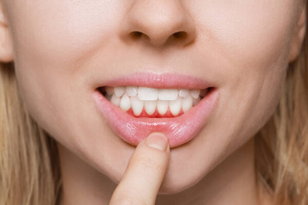 Woman showing inflamed gum, closeup. Oral cavity health
