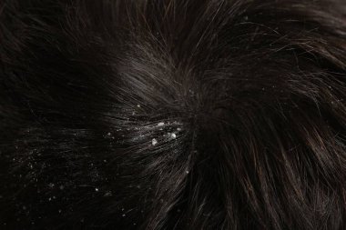 Koyu saçlı kepekli bir adam, makro manzaralı.