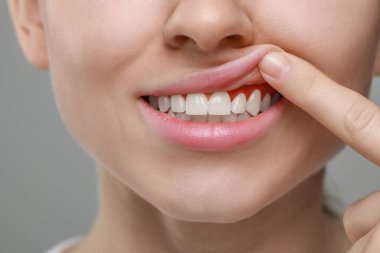 Gri arka planda iltihaplı sakız gösteren kadın, yakın plan.