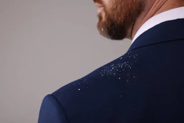Man Dandruff His Suit Grey Background Closeup Space Text — Stock Photo, Image