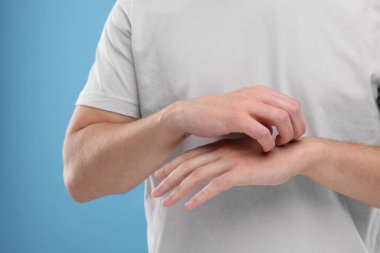 Alerji belirtileri. Açık mavi arka planda elini kaşıyan adam, yakın plan.