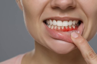 Gri arka planda iltihaplı sakız gösteren kadın, yakın plan.