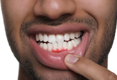 Beyaz arkaplanda iltihaplı sakız gösteren adam, yakın plan