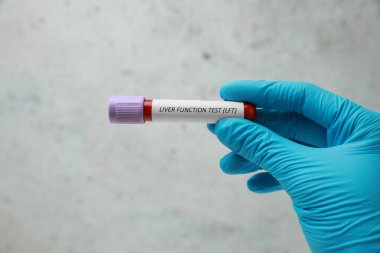 Laboratuvar çalışanı elinde kan örneği olan bir tüp tutuyor ve ışık arka planına karşı karaciğer fonksiyon testi etiketi koyuyor.