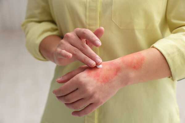 Женщина наносит лечебный крем на обожженную руку в помещении, крупным планом