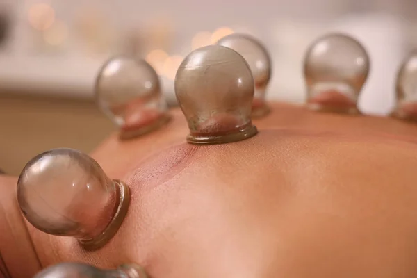 Cupping therapy. Closeup view of man with glass cups on his back indoors