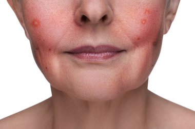 Beyaz arka planda Rosacea olan kadın, yakın plan. Sorunlu cilt tedavisi