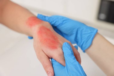 Hastanın yanık elini içeride muayene eden doktor, yakın plan.