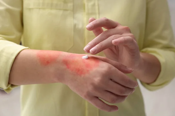 Woman applying healing cream onto burned hand indoors, closeup