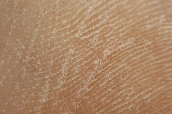 stock image Texture of dry skin as background, macro view