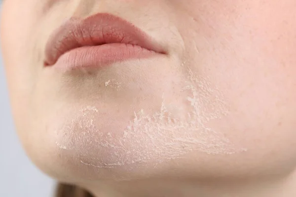 Closeup view of woman with dry skin
