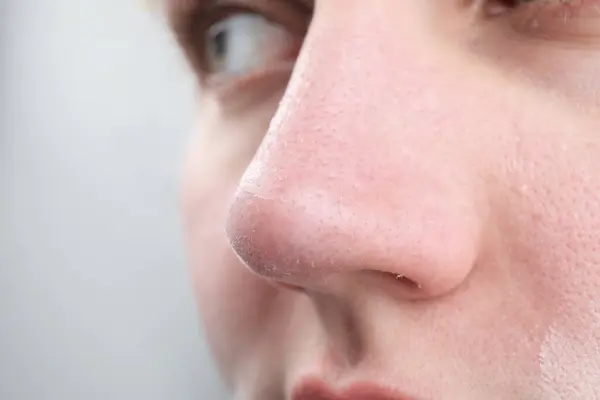 Woman with dry skin on nose against light background, closeup