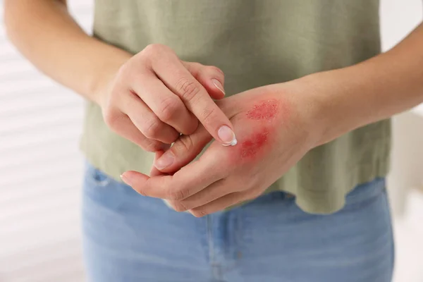 Woman applying healing cream onto burned hand indoors, closeup