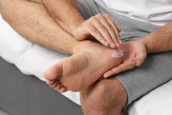 Man with dry skin applying cream onto his foot on bed, closeup