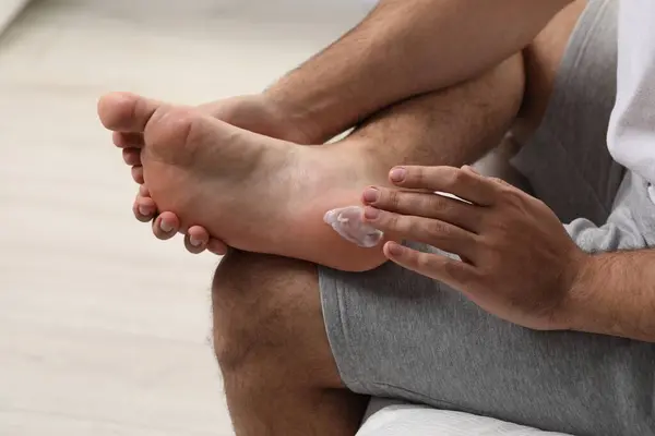 Man with dry skin applying cream onto his foot on bed, closeup