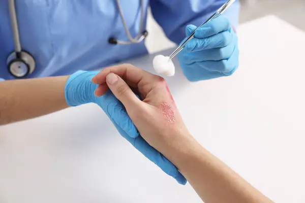 Doctor treating patient\'s burned hand at table, closeup