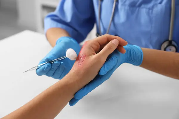 Doctor treating patient\'s burned hand at table, closeup