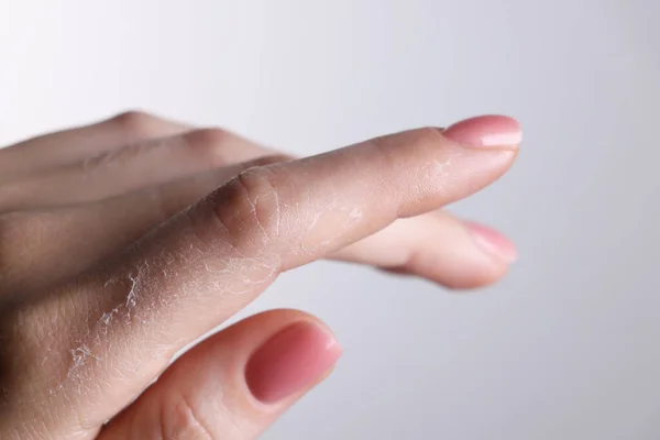 Woman with dry skin on hand against light background, macro view