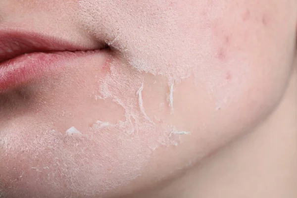 Woman with dry skin on face, closeup