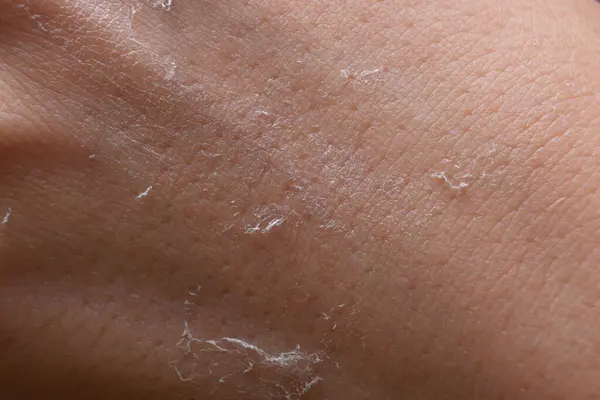 Woman with dry skin on hand, macro view