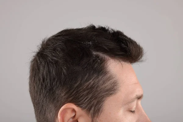 Man with dandruff in his dark hair on light gray background, closeup