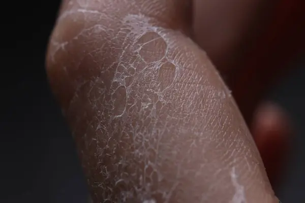 Woman with dry skin on hand, macro view