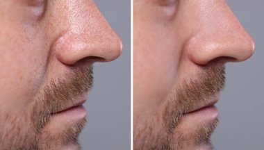 Siyah nokta tedavisi, önce ve sonra. Gri arkaplandaki adamın fotoğraflarıyla kolaj, yakın plan görünüm