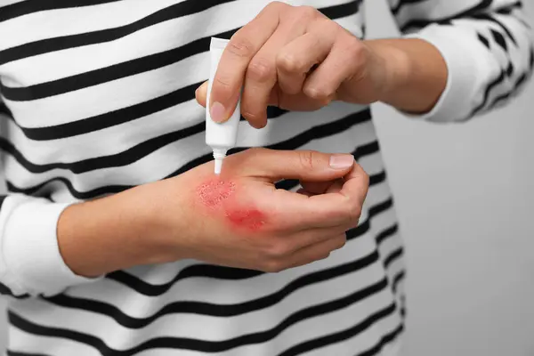 Woman applying healing cream onto burned hand on light grey background, closeup