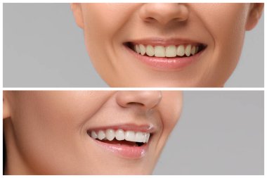 Gri arka planda beyazlamadan önce ve sonra dişlerini gösteren kadın, kolaj