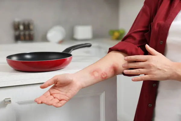 Woman with burns on her hand in kitchen, closeup