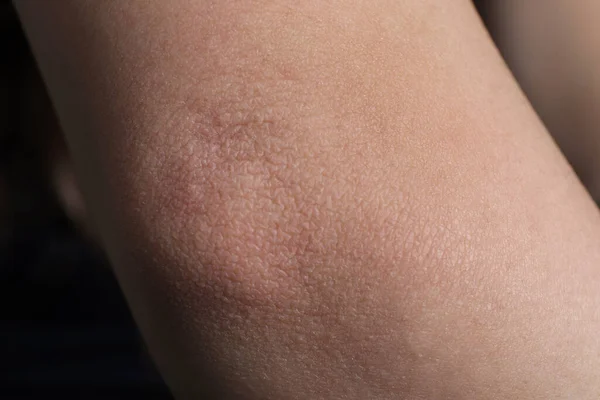 Woman with dry skin on elbow, closeup