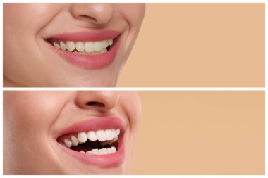 Dişlerini bej arka planda beyazlatmadan önce ve sonra gösteren kadın, kolaj