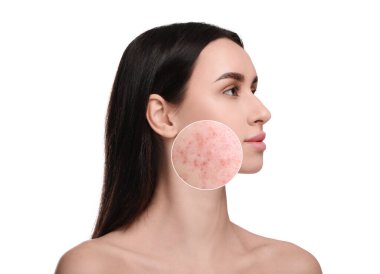 Beyaz arka planda kozmetoloji öncesi ve sonrası kadın. Yakınlaştırılmış alan sorunlu cildi gösteriyor