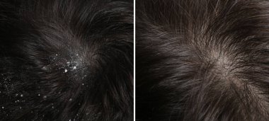 Kepek tedavisi öncesi ve sonrası saç gösteren adam, kolaj.