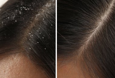 Kepek tedavisi öncesi ve sonrası saç gösteren bir kadın, kolaj.