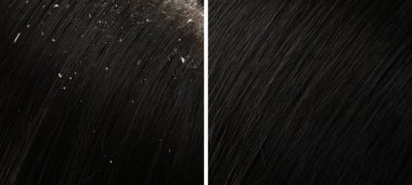 Kepek tedavisi öncesi ve sonrası saç gösteren bir kadın, kolaj.