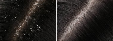 Kepek tedavisi öncesi ve sonrası saç gösteren bir kadın, kolaj.